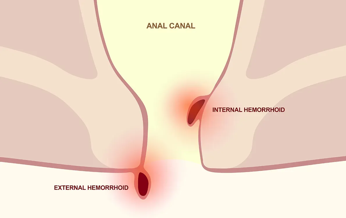 ProctoCor Treatment