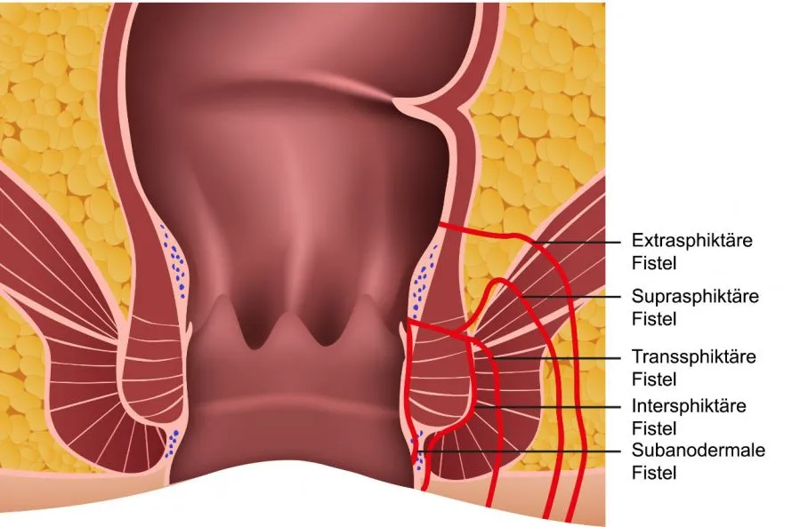 ProctoCor Treatment